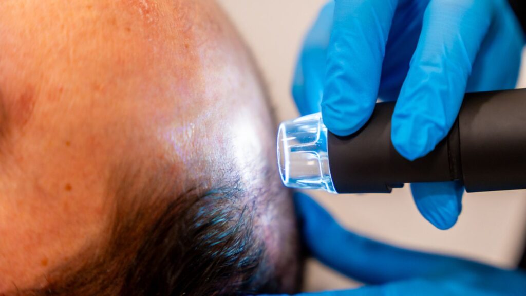 Close-up of the hands of a dermatologist applying laser treatment for bald man in a beauty clinic